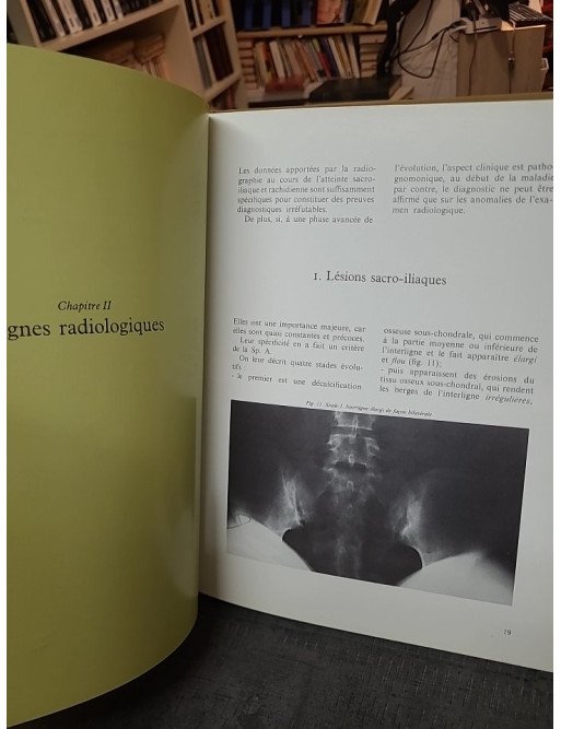 Spondylarthrite ankylosante : aspects cliniques et thérapeutiques